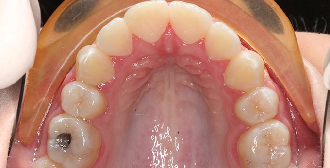 Adult upper teeth after Orthodontic treatment for severe dental crowding and misalignment